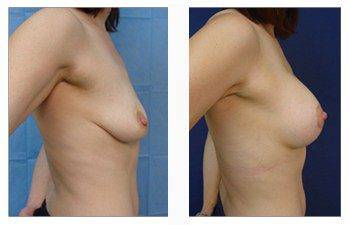 breast lift with implants patient 29 right view