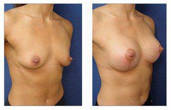 breast lift with implants patient 33 front right view