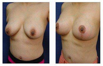 breast lift with implants patient 34 front left view