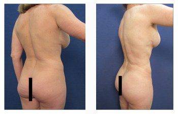 breast lift with implants patient 1 back right view