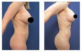 breast lift with implants patient 1 right view