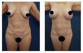 breast lift with implants patient 2 front view