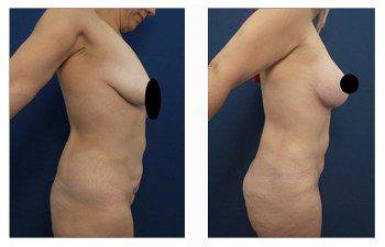 breast lift with implants patient 2 right view