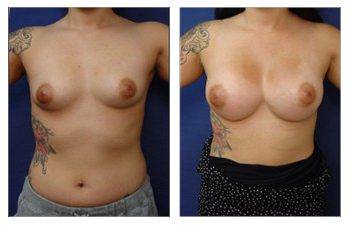 Natural Breast Augmentation (NBA)