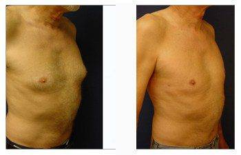 male breast surgery patient 1 front right view