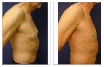 Gynecomastia