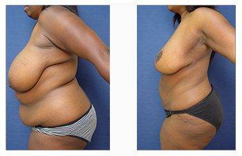 post bariatric surgery patient 16 left view