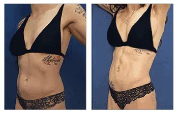 Before and after pictures of a woman's tummy tuck enhanced with 4D High Definition Liposuction.