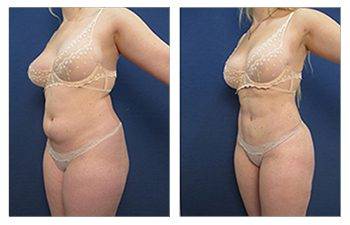 What Is The Safe Volume For Liposuction?