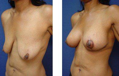 Breast Lift with Implants Cost