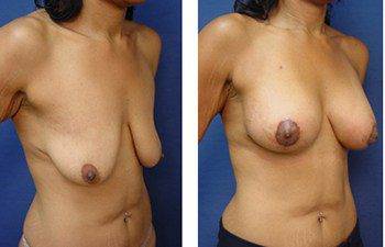 Before and after surgery image - Breast lift with implants cost