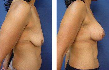 Before and after surgery image - Breast lift with implants cost