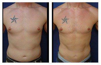 Gynecomastia Before and After Photos