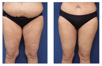 What is The Difference Between Lipedema and Lymphedema?