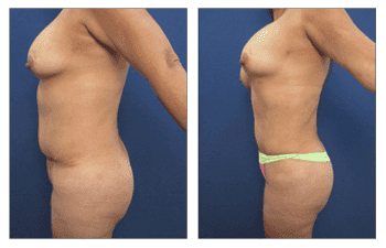 Liposuction