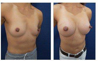 Breast Implant Surgery