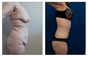 Post Bariatric Tummy Tuck