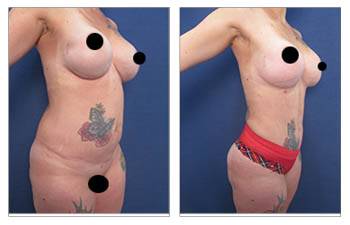 Fat Transfer, Tummy Tuck