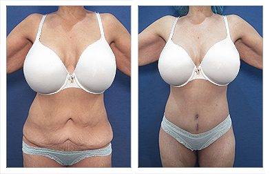 High Definition Tummy Tuck