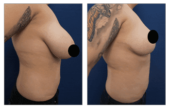 Breast Lift Surgery