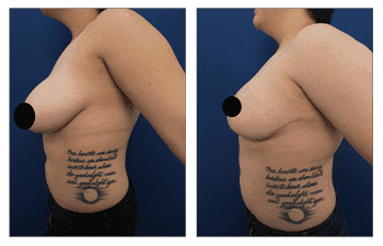 Breast Lift Surgery