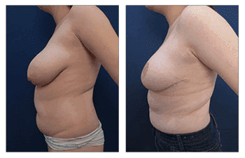 Breast Lift with Implant Exchange