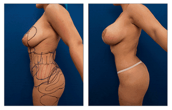 Power Assisted Liposuction