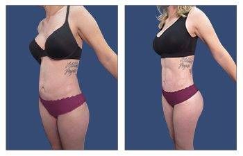 SurgiSculpt™ Cosmetic Plastic Surgery - Liposuction Landing Page