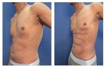 Best Way to Get a Square Chest: The Masculinized Chest.