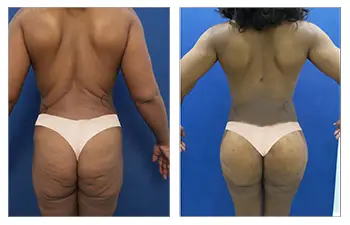 Nordesthetics clinic - BBL (Brazilian buttock lift surgery) is a  combination of liposuction and fat transfer to buttocks. At first, the fat  is taken from a certain body area (abdomen, back, thighs