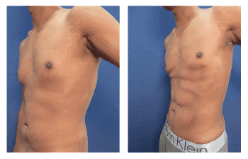 vaser lipo UK patient 2 front left view