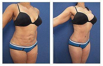 Cold vs. Hot: Comparing Modalities for Body Sculpting - Van Raalte, Ben  ()