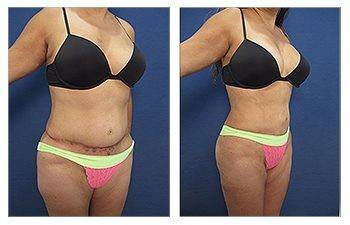 Unsightly scars after abdominoplasty - Hourglass Tummy Tuck