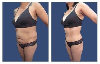 SurgiSculpt™ Cosmetic Plastic Surgery - Liposuction Landing Page