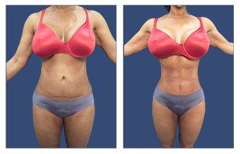 Renuvion J Plasma Tummy Tuck Before and After