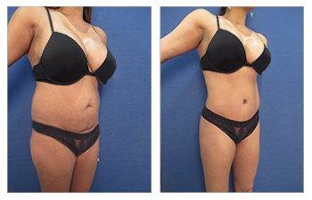 How To Liposuction Love Handles For Best Results - Moein Surgical Arts