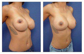 Treatment of Bottoming out Following Breast Augmentation