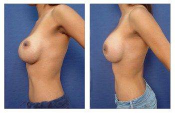 Treatment of Bottoming out Following Breast Augmentation