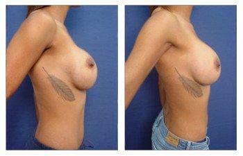 Results after Treatment of Bottoming out Following Breast Augmentation