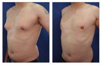 Gynecomastia