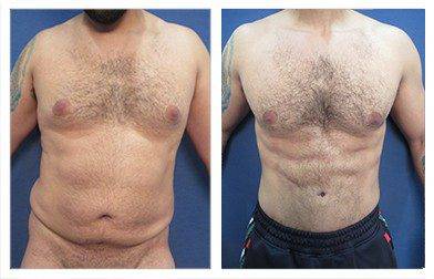 Liposuction Cost: Understand the InvestmentMale Plastic Surgery