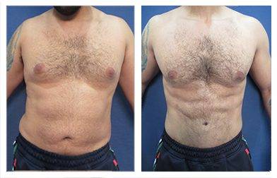 Liposuction - Abdominal Etching & Sculpting Before and After Photo Gallery, Los Angeles, CA