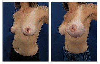 left front oblique Avoiding Breast Asymmetry During Breast Augmentation