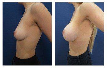 Breast Augmentation Silicone