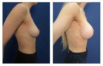 Silicone implants Dana Point