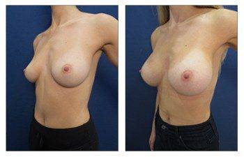 Breast augmentation Laguna Beach