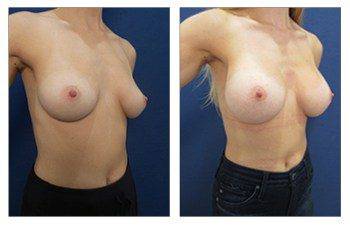 Breast lift Los Angeles