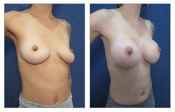 Breast Augmentation Newport Beach