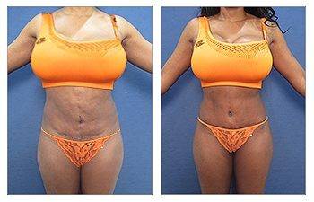 Best Liposuction Revision