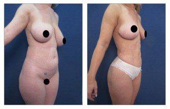 Vaser Lipo - High Definition Liposuction Results